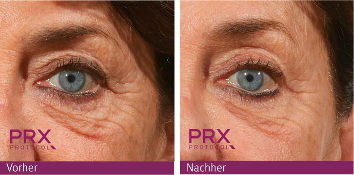 DIE NADELFREIE BIOREVITALISIERUNG